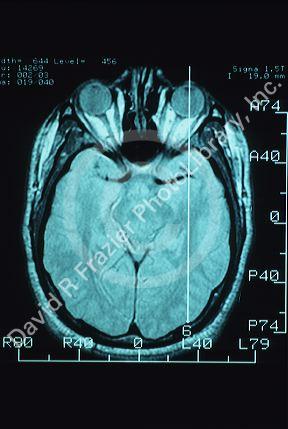 An MRI image showing bone and tissue of the head.