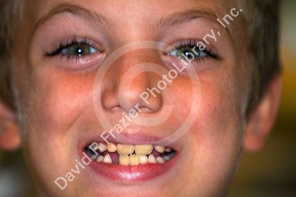 Seven year old boy with missing tooth.