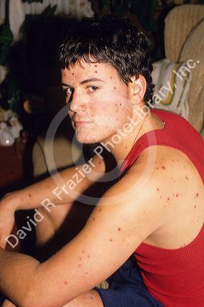 A teenager with chicken pox.