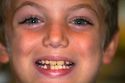 Seven year old boy with missing tooth.