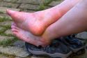 Swollen, sore feet of a pilgrim at Puente La Reina a Basque town along the Way of St. James pilgrimage route, Navarra, Spain.
